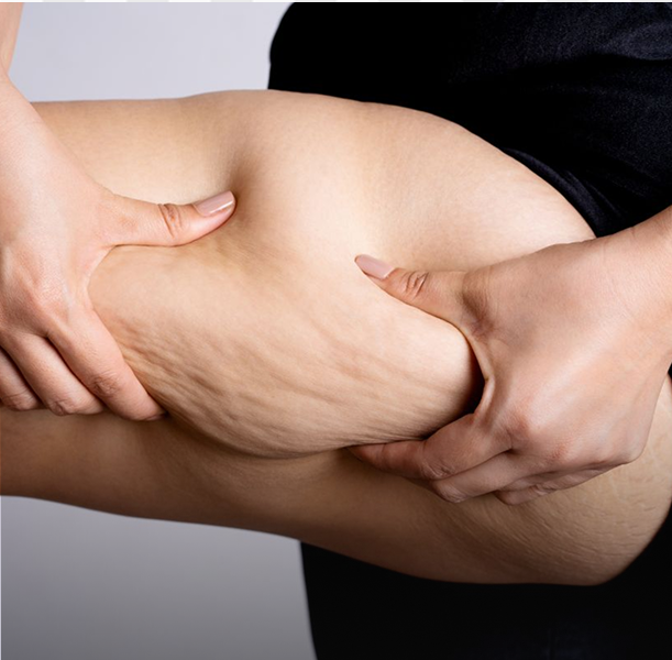 Tratamiento para la celulitis