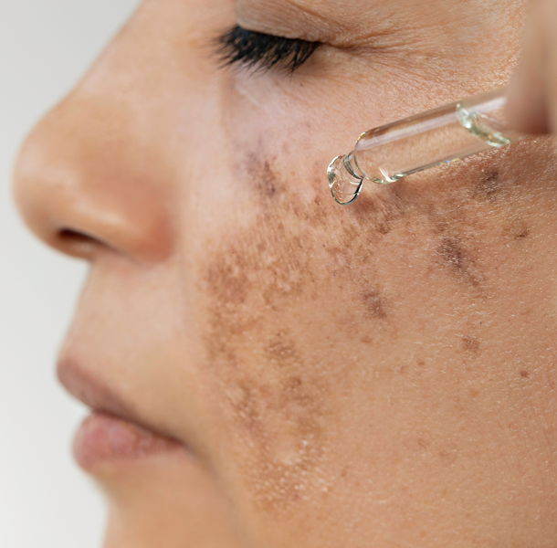 Tratamiento Melasma