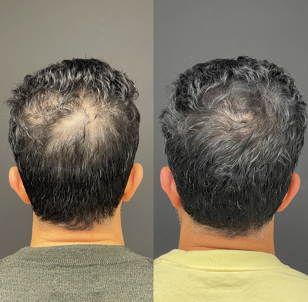 Mesoterapia Capilar