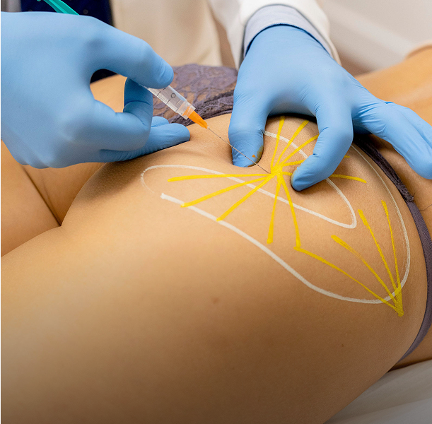 Mesoterapia Corporal