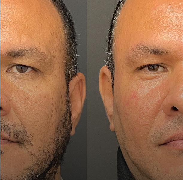 Shaving + Electrocoagulación
